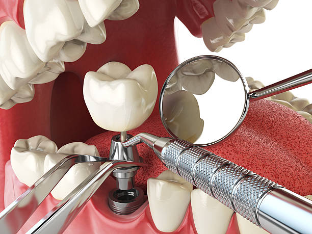 Best Broken or Chipped Tooth Repair in Gig Harbor, WA